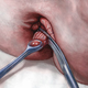 Illustration for article titled Penyakit Wasir Ke Dokter Apaem/em